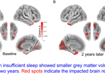 The Effects of Insufficient Sleep on Brain Structural Measurements