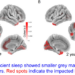 The Effects of Insufficient Sleep on Brain Structural Measurements