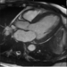 Image: CMR of a patient showing evidence of myocardial hypertrophy (thickening of heart muscles) due to hypertension.