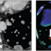 59-year-old man with renal cancer and multiple lung metastases who underwent conventional contrast-enhanced chest CT