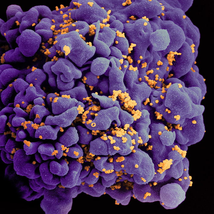 Scanning electron micrograph of an HIV-infected H9 T cell.