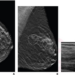 72-year-old woman recalled from screening mammography for architectural distortion in left breast