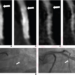 57-year-old man who underwent coronary CTA using two-breath-hold subtraction technique to assess patency of coronary artery stent.