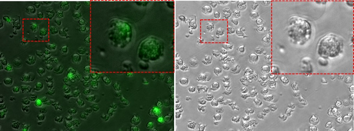 Acute lymphoblastic leukemia cells