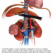 Anatomy of the kidneys, liver and heart with the inferior vena cava, and surgical intervention to treat cancer