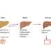 Non-alcoholic fatty liver disease progression