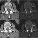 Novel Photon-Counting CT Improves Myeloma Bone Disease Detection