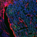 The melanoma-astrocytes interactions