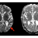 Simple blood test predicts neurotoxic complications of CAR-T cell therapy