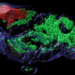 Cellules tumorales (rouge) cultivées dans une microstructure (tissu hôte; vert) appelée organoïde. Le laboratoire Rubin a développé des organoïdes qui serviront d'outil pour étudier les tumeurs dérivées de patients et patientes au niveau cellulaire.