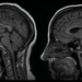 Patient with spinocerebellar ataxia