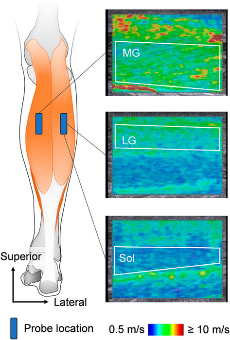 Schematic of ultrasound probe locations and ultrasound shear wave elastography images.