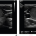 TI-RADS, Algorithm Guide Diagnoses of Pediatric Thyroid Nodules on Ultrasound