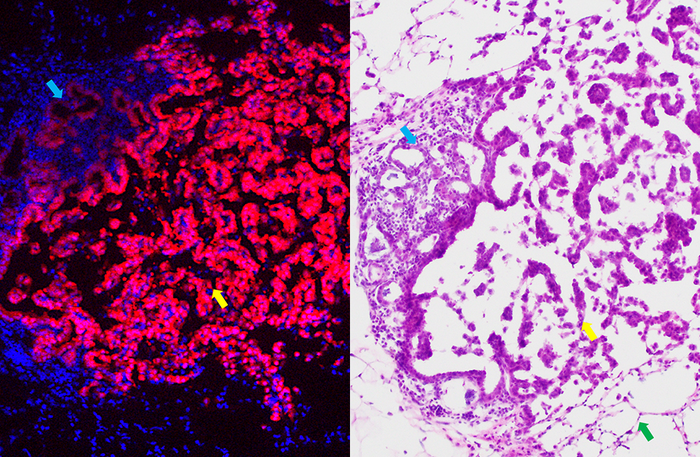 NIH Grant Funds Cancer Prevention Vaccine Research