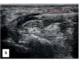 Non-Surgical Treatment Relieves Carpal Tunnel Syndrome