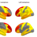 Obesity Linked to Poor Brain Health in Children