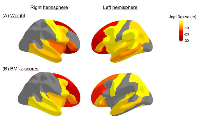 Obesity Linked to Poor Brain Health in Children