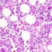 Study reveals how chronic blood cancer transitions to aggressive disease