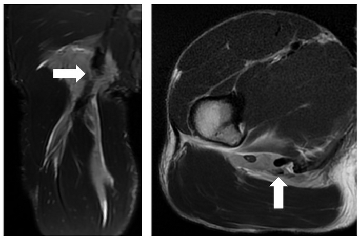 Tears in Tokyo: Muscle–tendon injuries during Olympic competition can