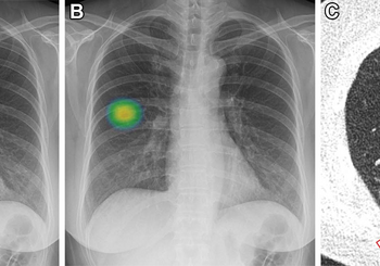 AI Improves Lung Nodule Detection on Chest X-rays
