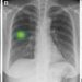 AI Improves Lung Nodule Detection on Chest X-rays