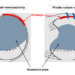 Comparing surgeries for repairing a torn meniscus in young patients