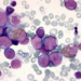 Leukemic blasts