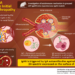 Pathogenesis of IgA nephropathy revealed in this study.