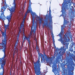 Figure 1: Patches of fibrosis (blue) and fat (white) tissue in the heart of an ACM patient. Heart muscle cells are shown in red.