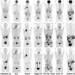 Maximum-intensity projection images of 18F-fluorodeoxyglucose (FDG), 68Ga-FAP-2286, and 68Ga-FAPI-46 PET/CT imaging in seven patients with different types of cancer.