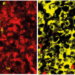 Multiple myeloma