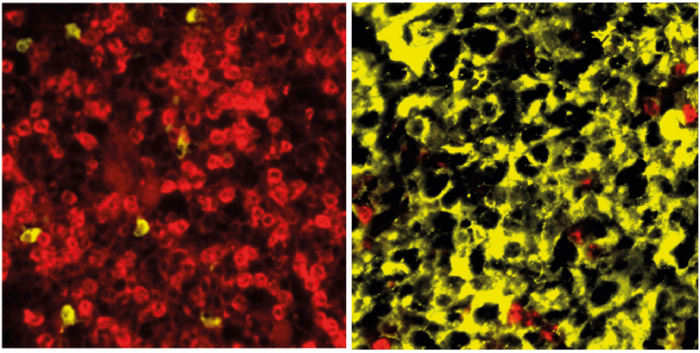 Multiple myeloma