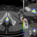 Heat map of prostate bed PSMA PET recurrences distribution mapped on a template patient’s anatomy.