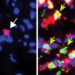 SURPRISE FINDING SHOWS THAT NEUTROPHILS CAN BE KEY ANTITUMOR WEAPONS