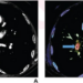 54-year-old with mild chest pain for 3 days who underwent CTPA to assess acute PE