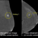 Example of “downgrading” finding to a less conspicuous finding