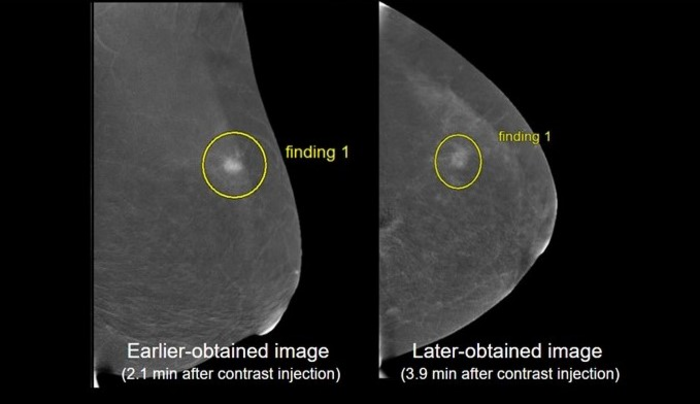 Example of “downgrading” finding to a less conspicuous finding