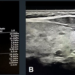 Gray-scale features of markedly hypoechoic thyroid nodule with irregular margin (TIRADS-4), confirmed as papillary thyroid carcinoma