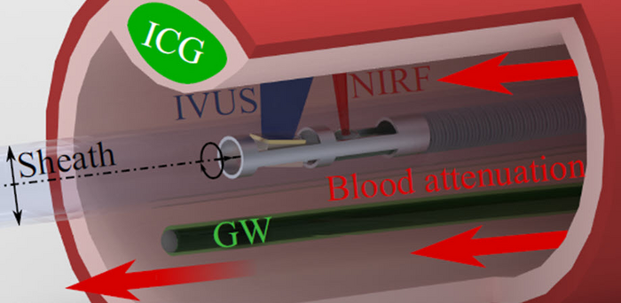 Improving accuracy of near-infrared fluorescence in cardiovascular imaging.