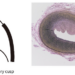 The First Molecular Autopsy Diagnosed Noonan Syndrome Case (IMAGE 1); (IMAGE 2)