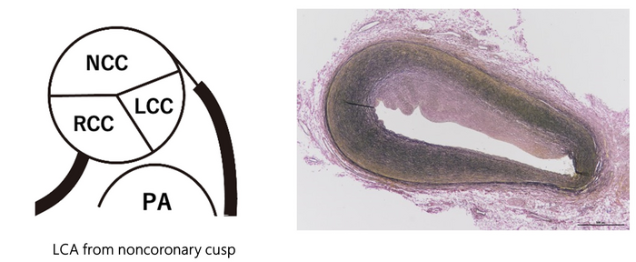 The First Molecular Autopsy Diagnosed Noonan Syndrome Case (IMAGE 1); (IMAGE 2)