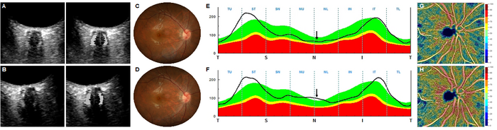 Results from a 30-year-old woman with acute mountain sickness (Lake Louise Questionnaire Score = 4) after exposure to a simulated high altitude using a hypobaric hypoxic chamber.