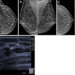 Ultrasound Effective at Diagnosing Localized Breast Lumps, Pain