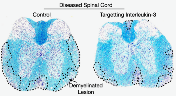 Interleukin-3 Associates with Human RRMS and Exacerbates Spinal Cord Inflammation