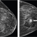 85-year-old patient who maintained daily use of 81 mg of aspirin at time of stereotactic-guided core-needle biopsy of group of breast calcifications; pathologic assessment yielded atypical ductal hyperplasia.