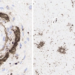 Most striking findings - mononuclear attack