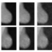 Influence of visual hindsight bias in mammogram reading.