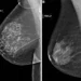 AI Outperformed Standard Risk Model for Predicting Breast Cancer