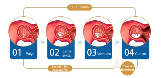 Progrssion of colorectal cancer