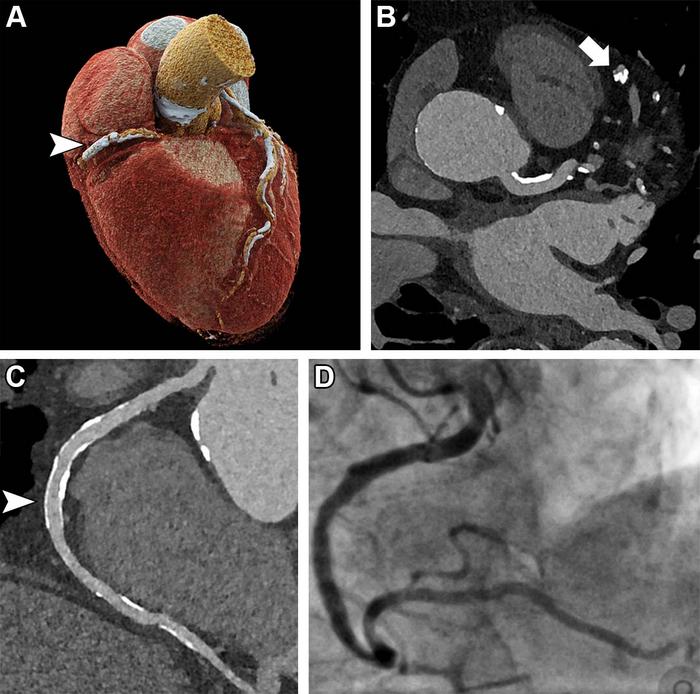 Ultrahigh-resolution coronary CT angiography in an 85-year-old man before transcatheter aortic valve replacement.